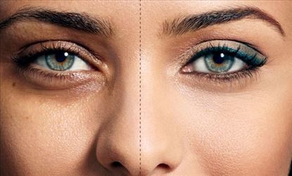 Getting rid of puffy eyes is an easy task